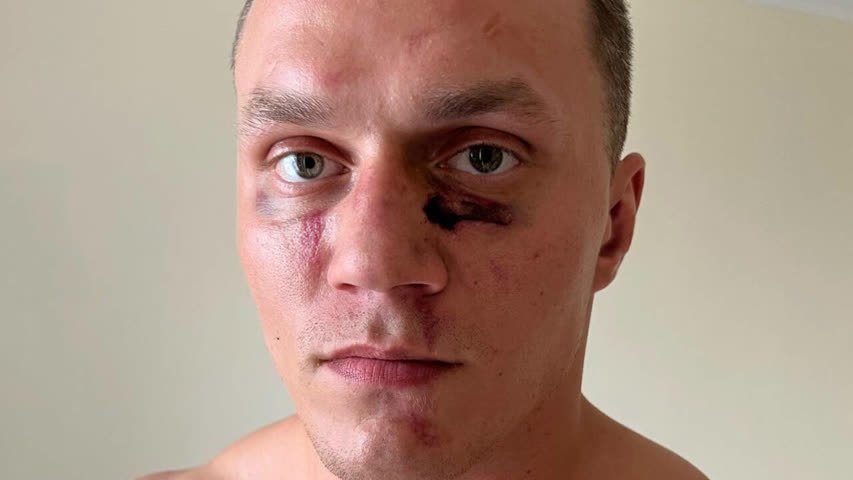 Фото - Блогер Тарасов показал лицо после поражения в кулачном бою техническим нокаутом